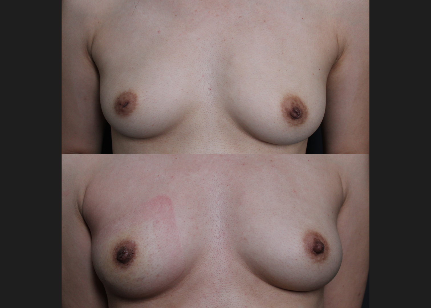 388186 Inverted nipple correction before after 1 week- front