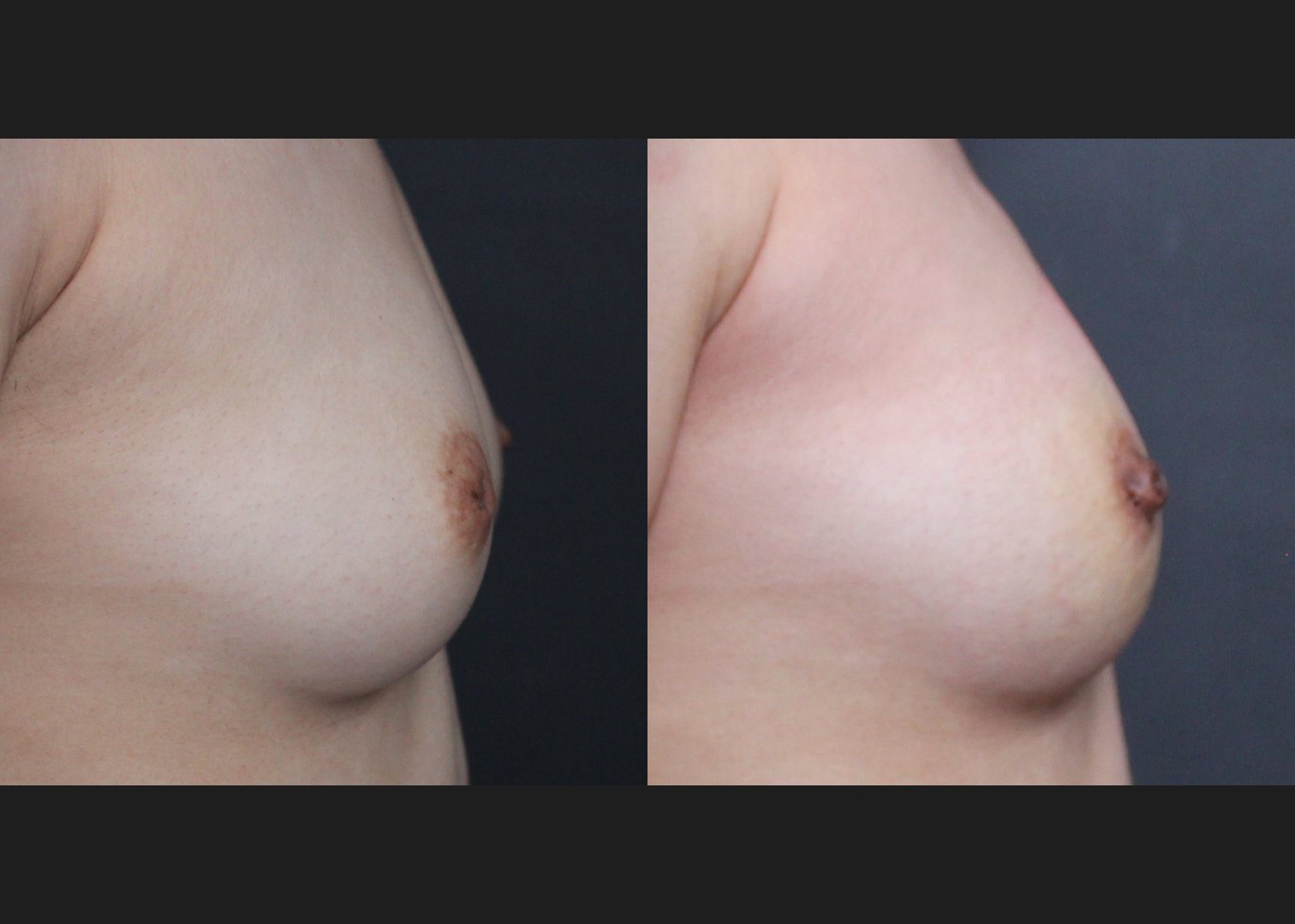 388186 Inverted nipple correction before after 1 week- right