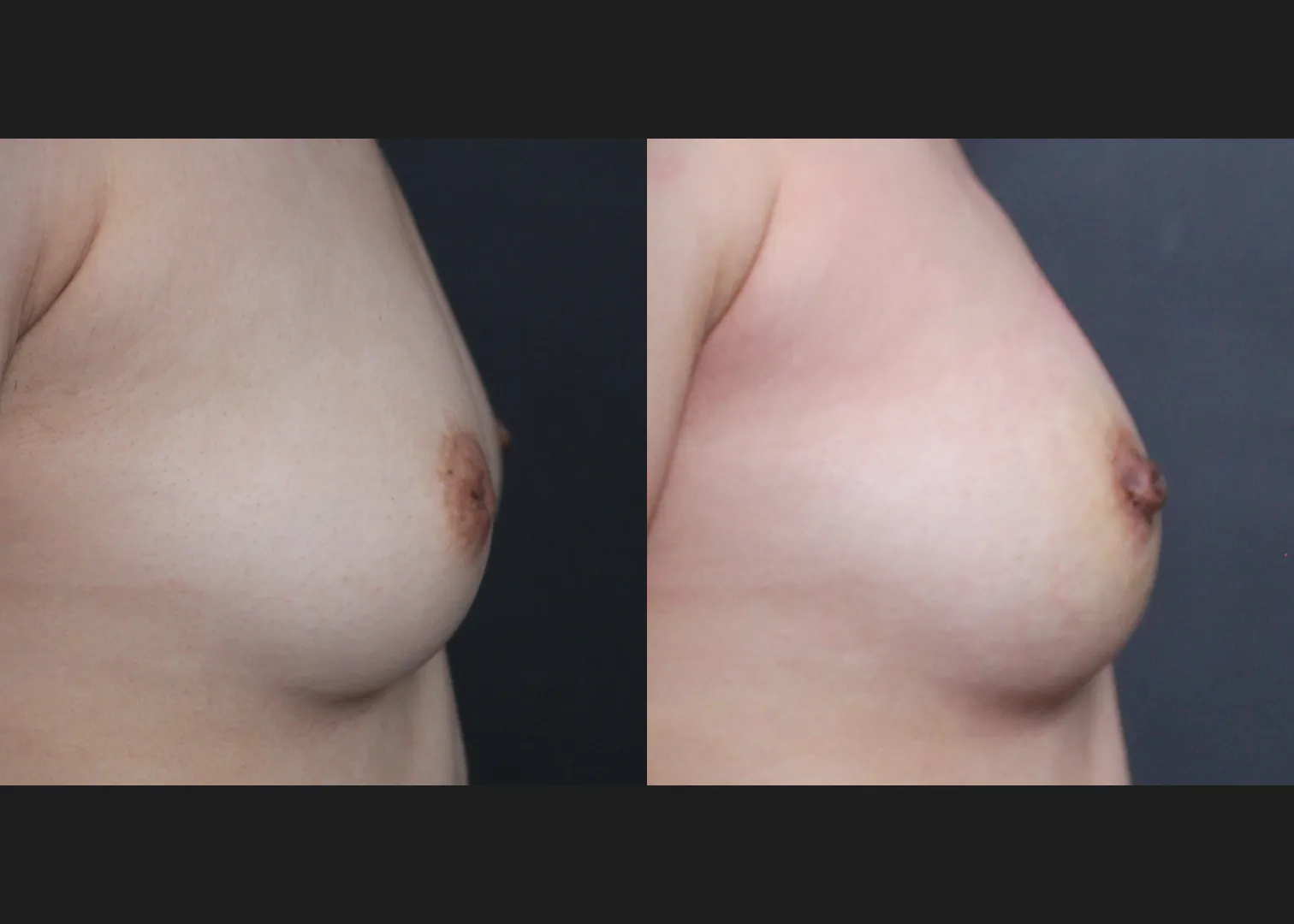388186 Inverted nipple correction before after 1 week- right