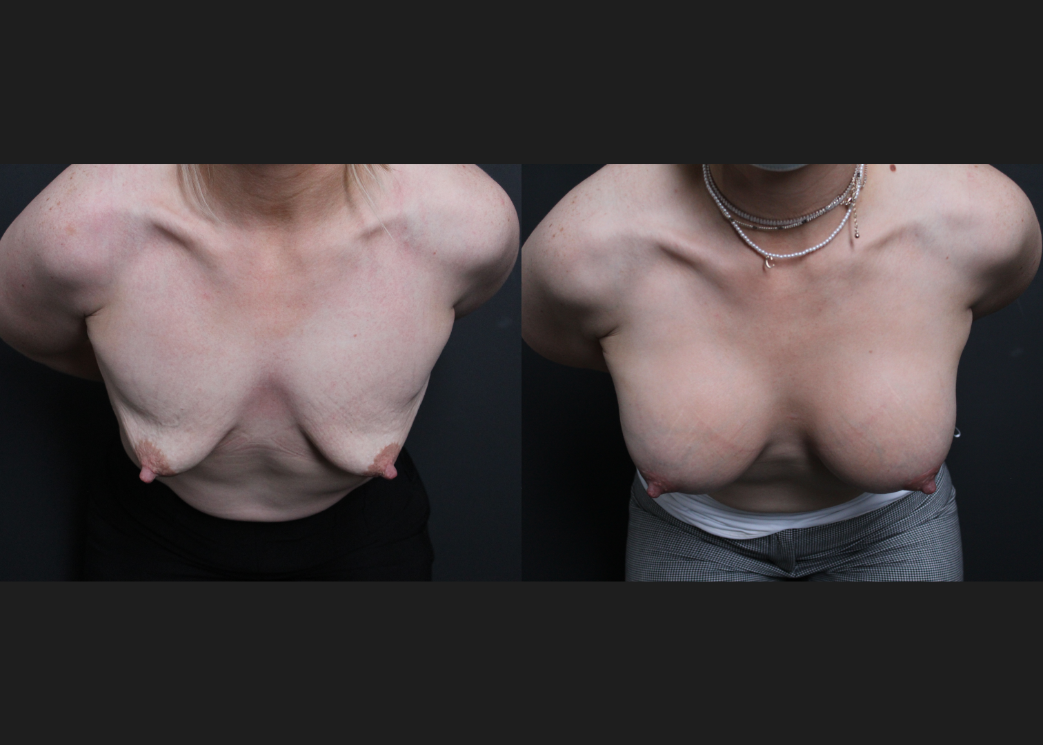 388191 Breast Augmentation Mastopexy Lollipop lift tuberous deformity Natrelle Inspira smooth round full profile SSF 345 cc subfascial before after- cleavage