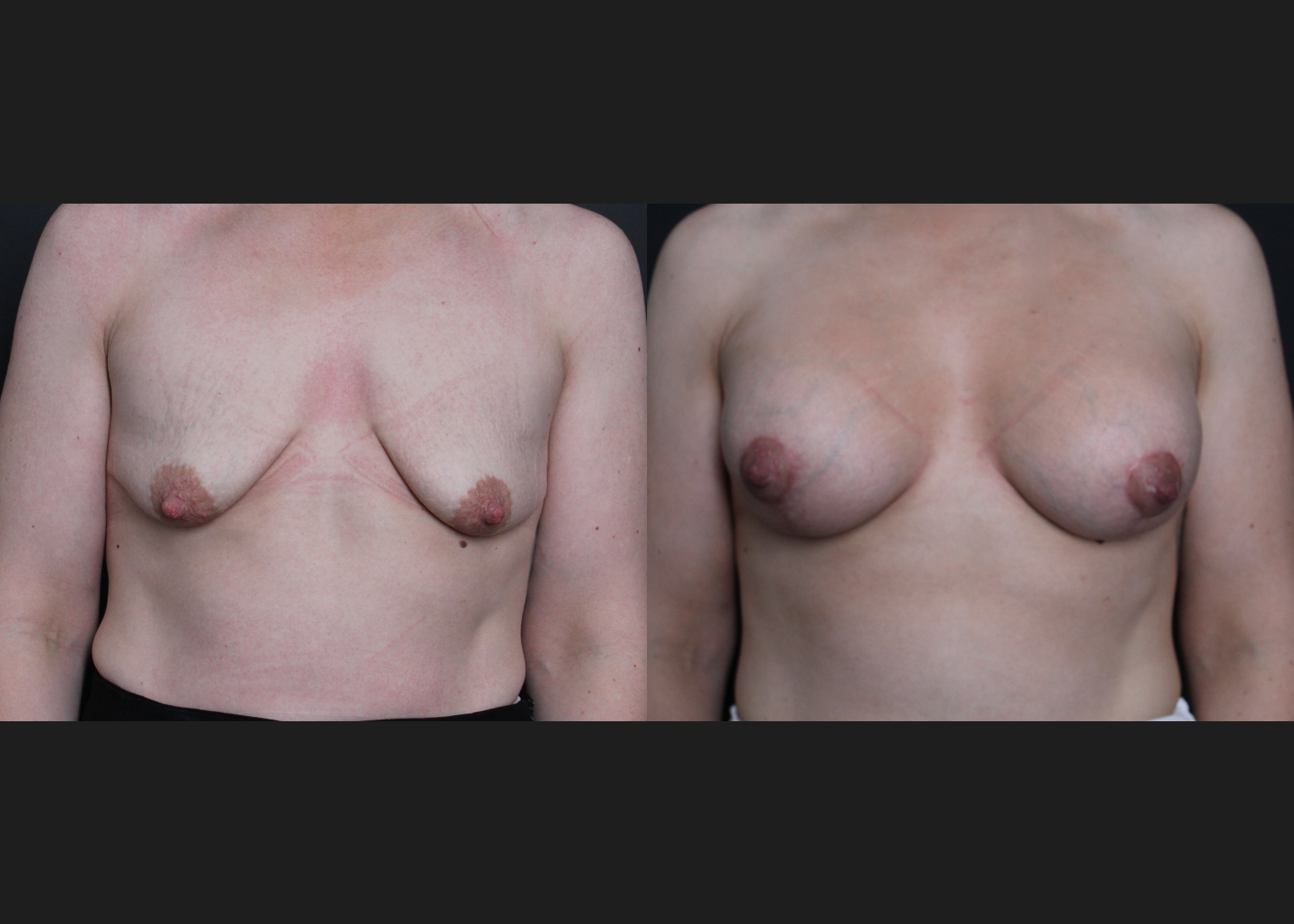 388191 Breast Augmentation Mastopexy Lollipop lift tuberous deformity Natrelle Inspira smooth round full profile SSF 345 cc subfascial before after- front