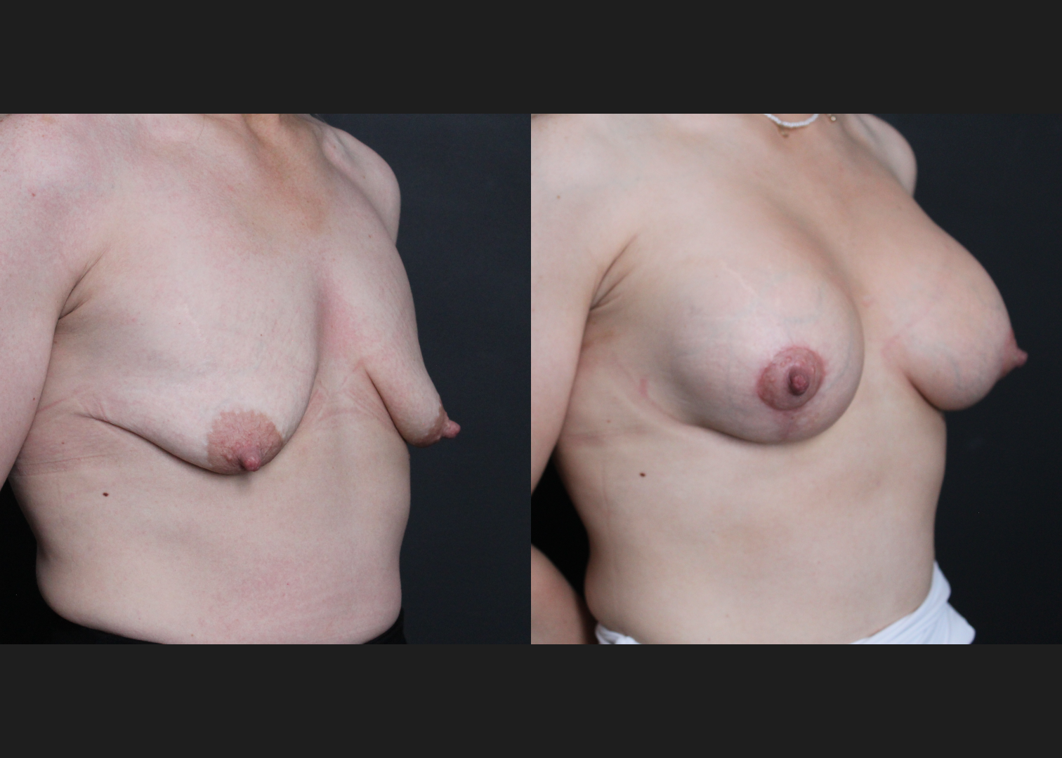 388191 Breast Augmentation Mastopexy Lollipop lift tuberous deformity Natrelle Inspira smooth round full profile SSF 345 cc subfascial before after- right oblique