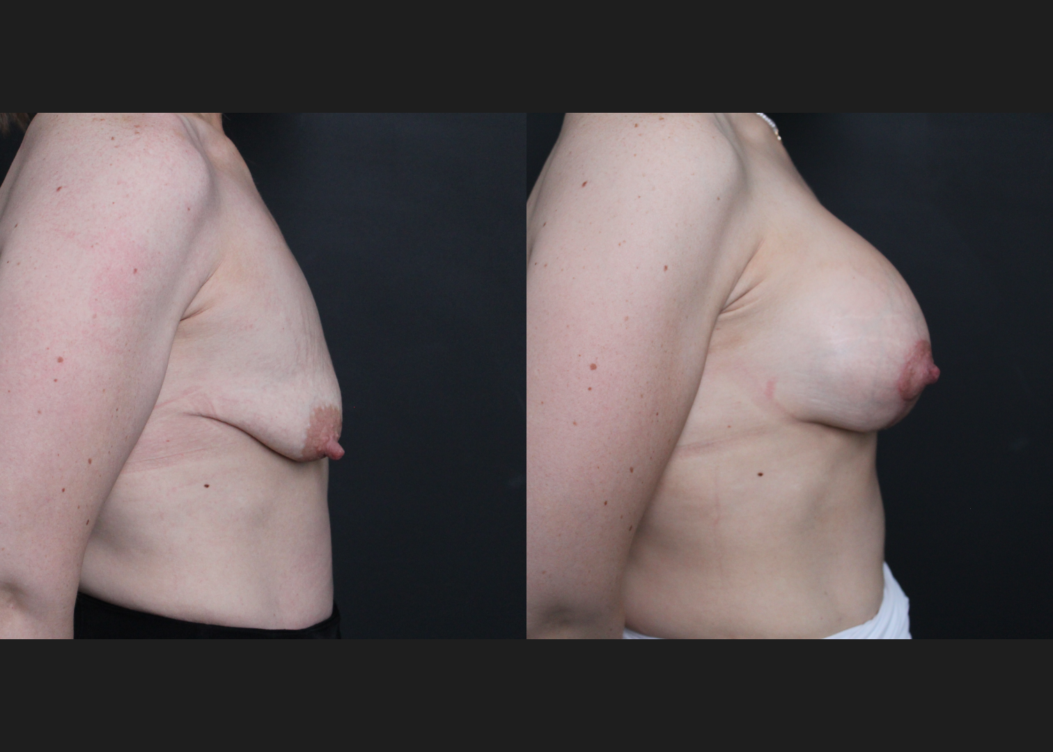 388191 Breast Augmentation Mastopexy Lollipop lift tuberous deformity Natrelle Inspira smooth round full profile SSF 345 cc subfascial before after- right