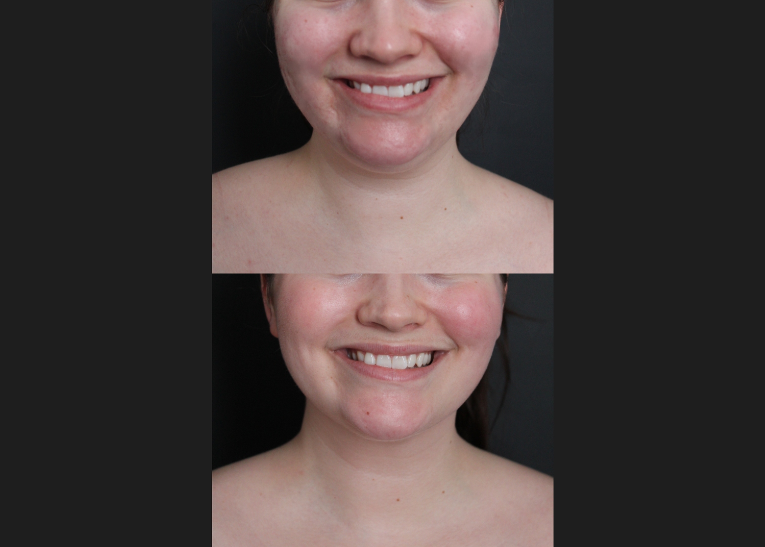 389566 Submental liposuction female before after 1 year- front smile