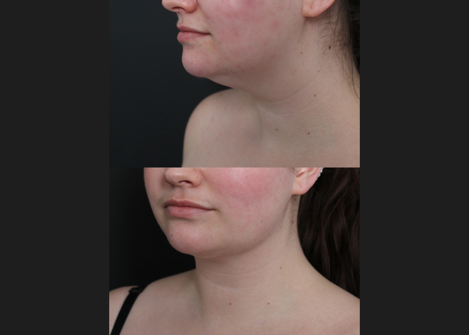 389566 Submental liposuction female before after 1 year- left oblique