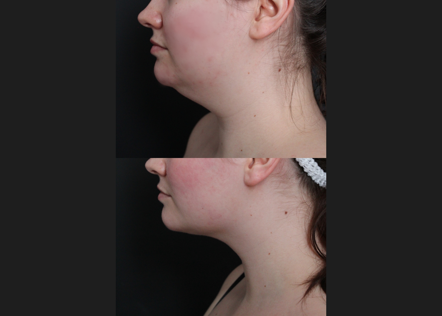 389566 Submental liposuction female before after 1 year- left