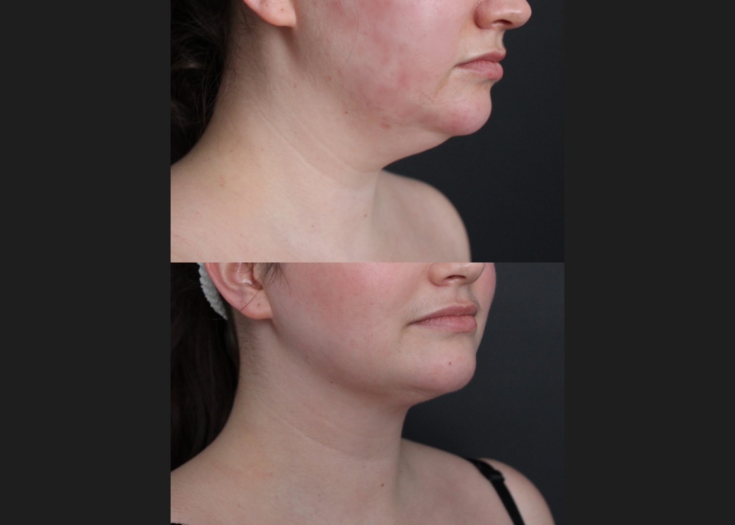 389566 Submental liposuction female before after 1 year- right oblique