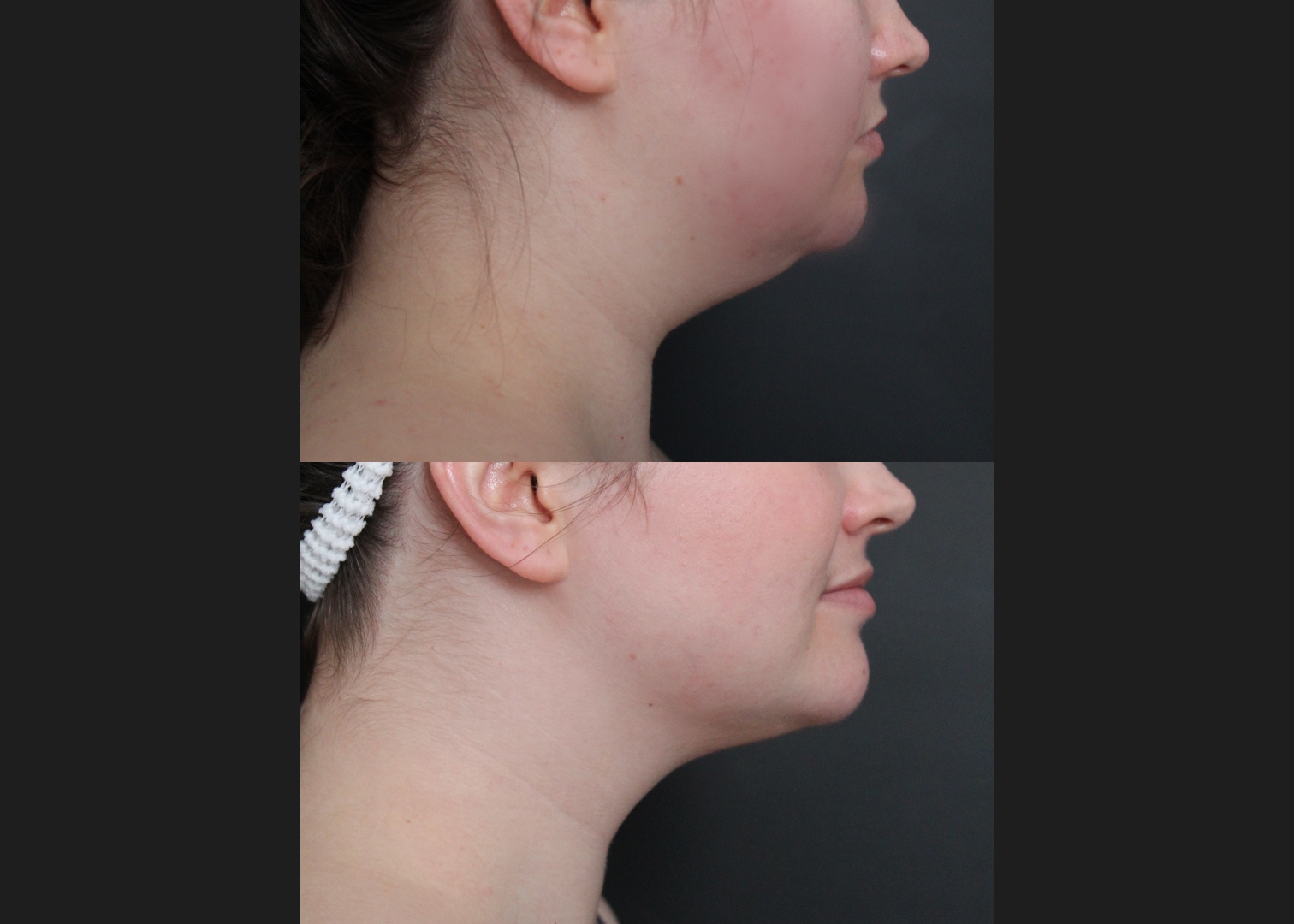 389566 Submental liposuction female before after 1 year- right