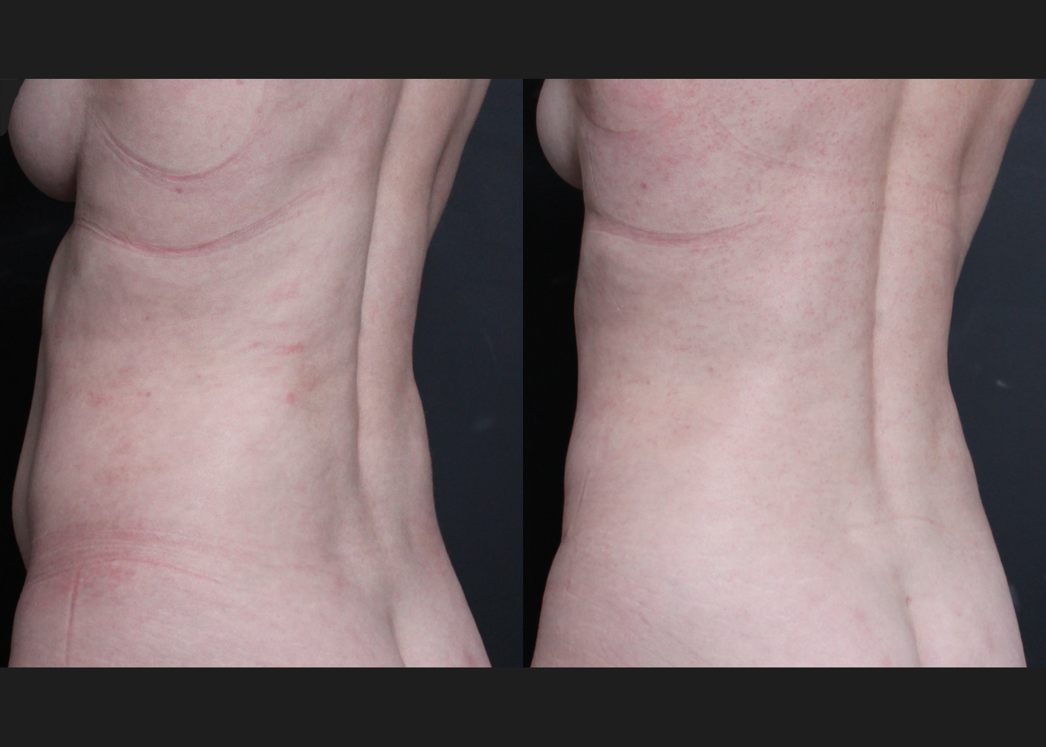 390638 Abdominoplasty rectus diastasis repair lower back flank VASER lipo before after- back left oblique