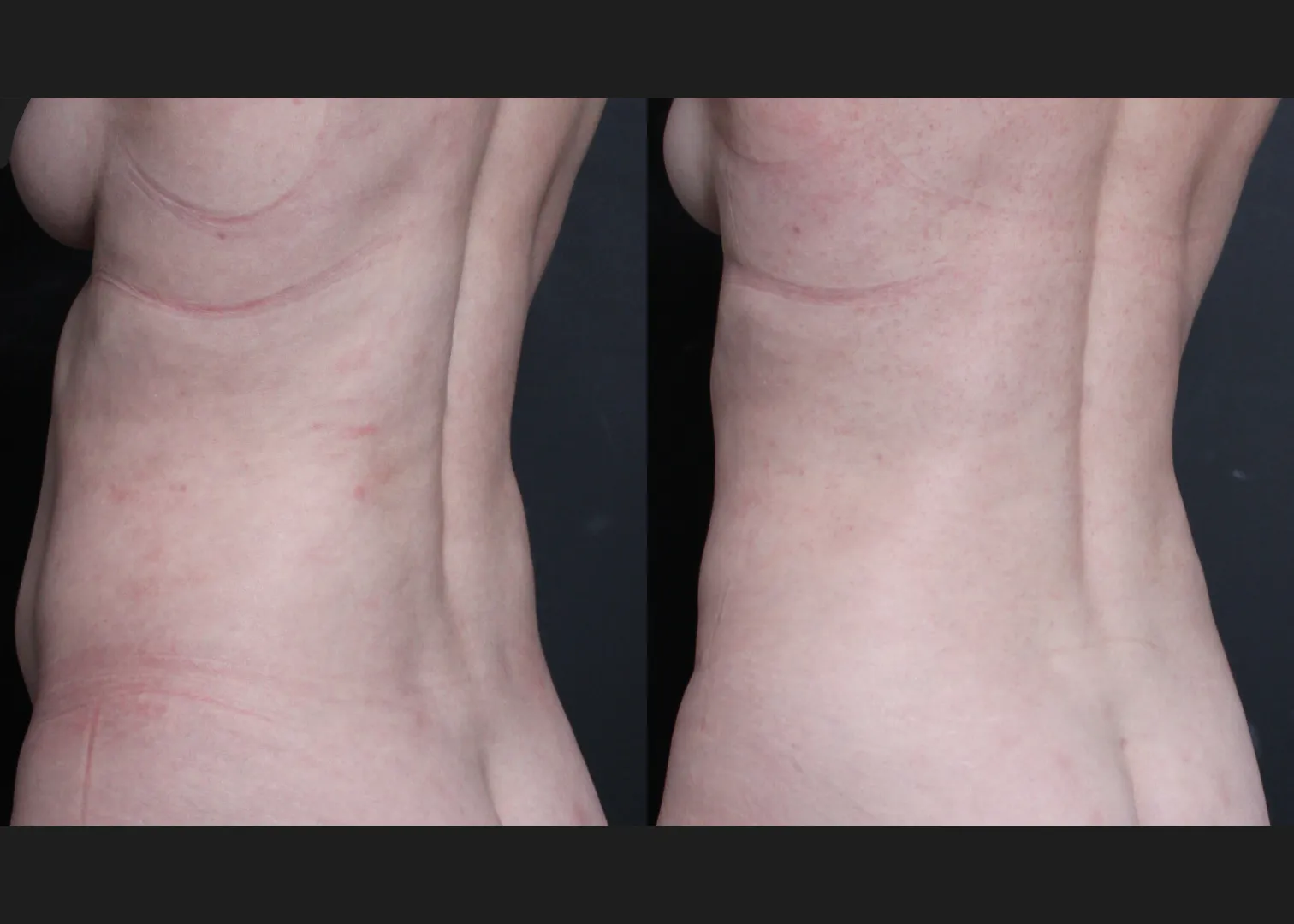 390638 Abdominoplasty rectus diastasis repair lower back flank VASER lipo before after- back left oblique