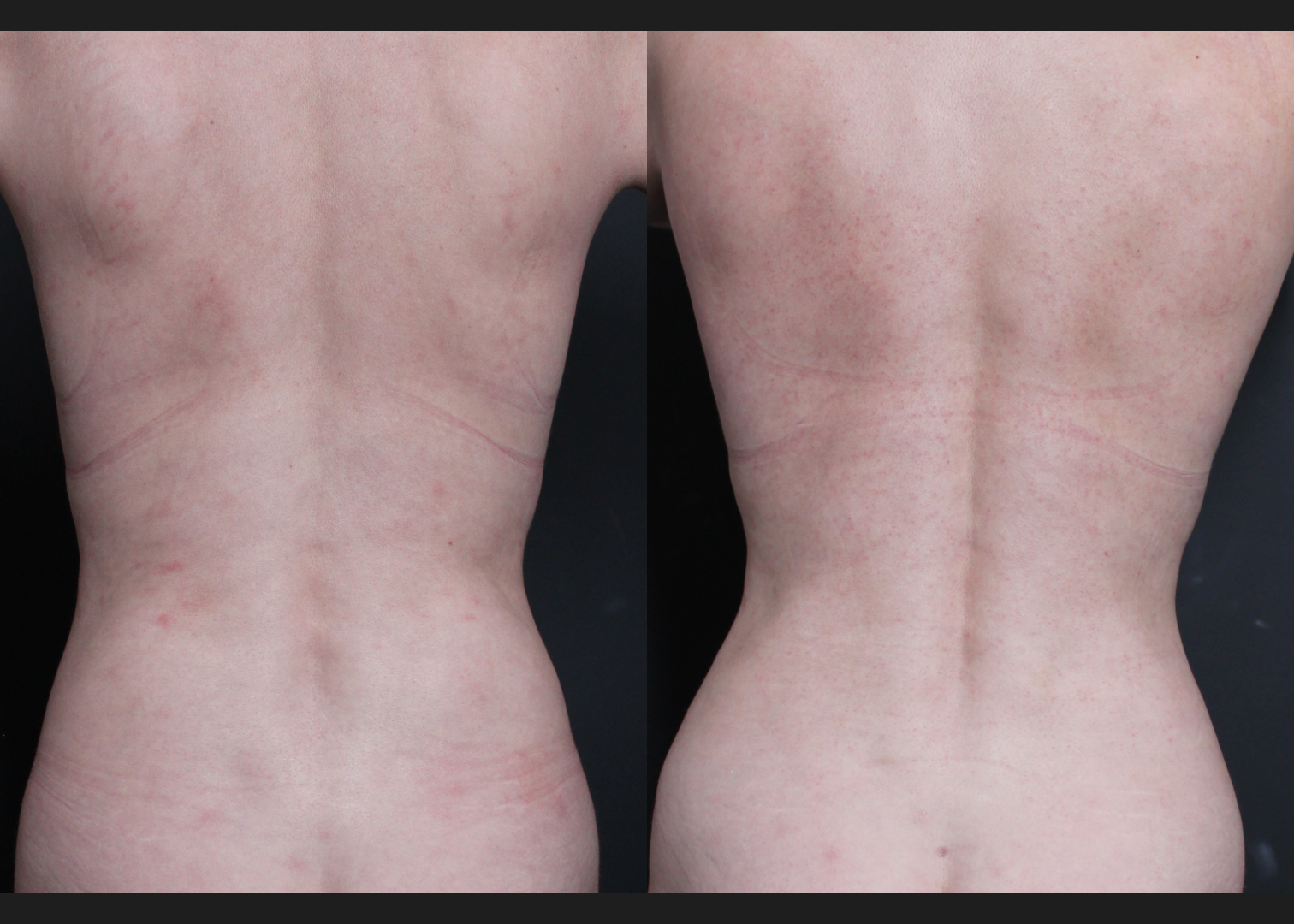 390638 Abdominoplasty rectus diastasis repair lower back flank VASER lipo before after- back