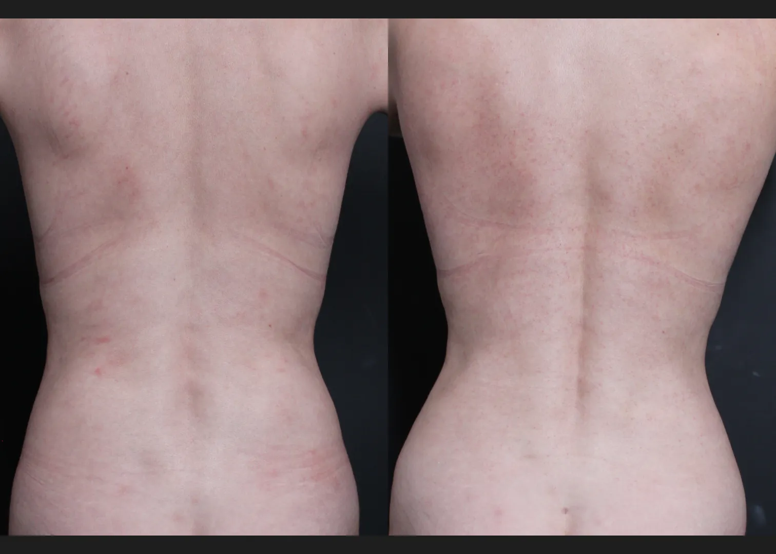 390638 Abdominoplasty rectus diastasis repair lower back flank VASER lipo before after- back