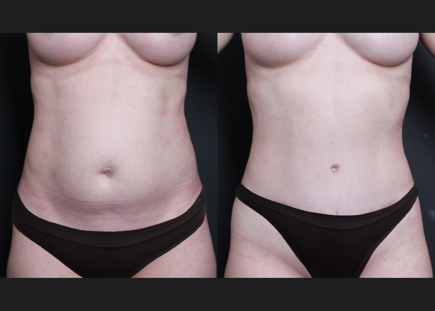 390638 Abdominoplasty rectus diastasis repair lower back flank VASER lipo before after- front
