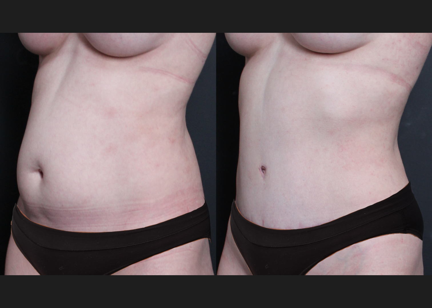 390638 Abdominoplasty rectus diastasis repair lower back flank VASER lipo before after- left oblique