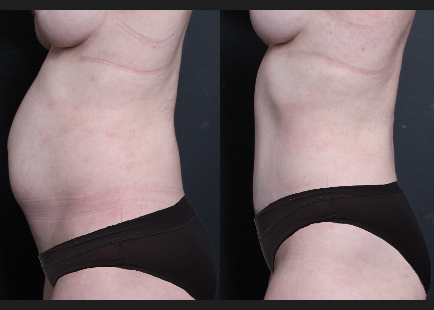 390638 Abdominoplasty rectus diastasis repair lower back flank VASER lipo before after- left