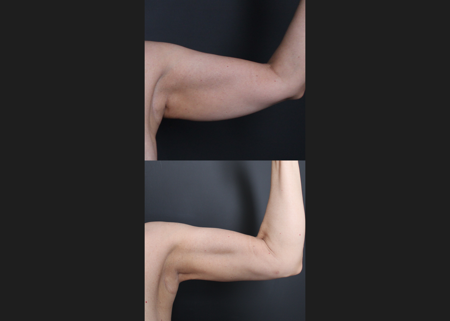 391438 Arm Vaser lipo renuvion before after- left ant