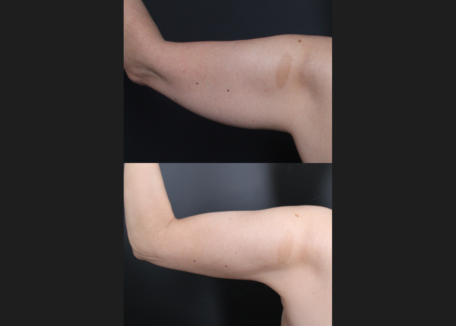 391438 Arm Vaser lipo renuvion before after- left post