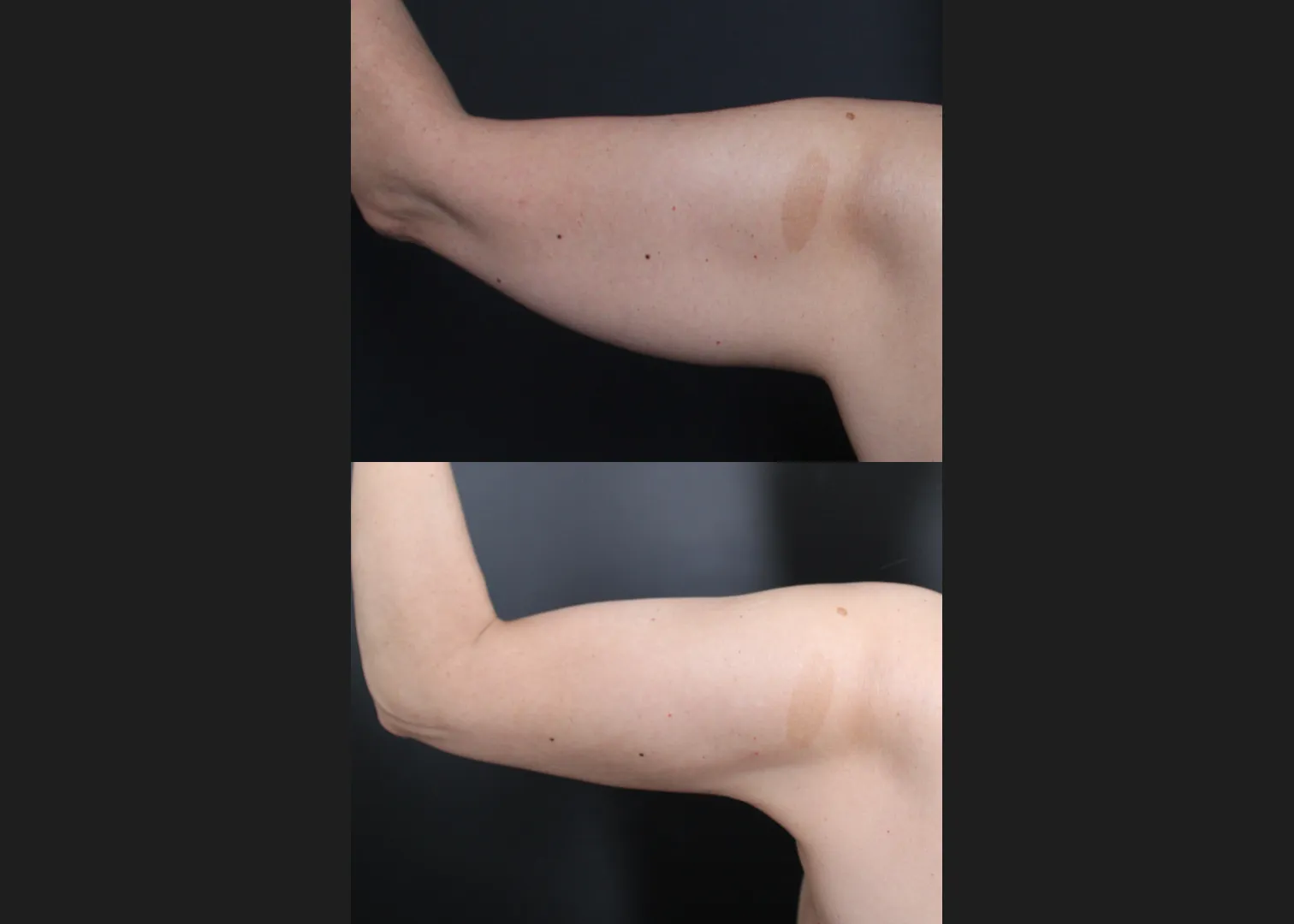 391438 Arm Vaser lipo renuvion before after- left post