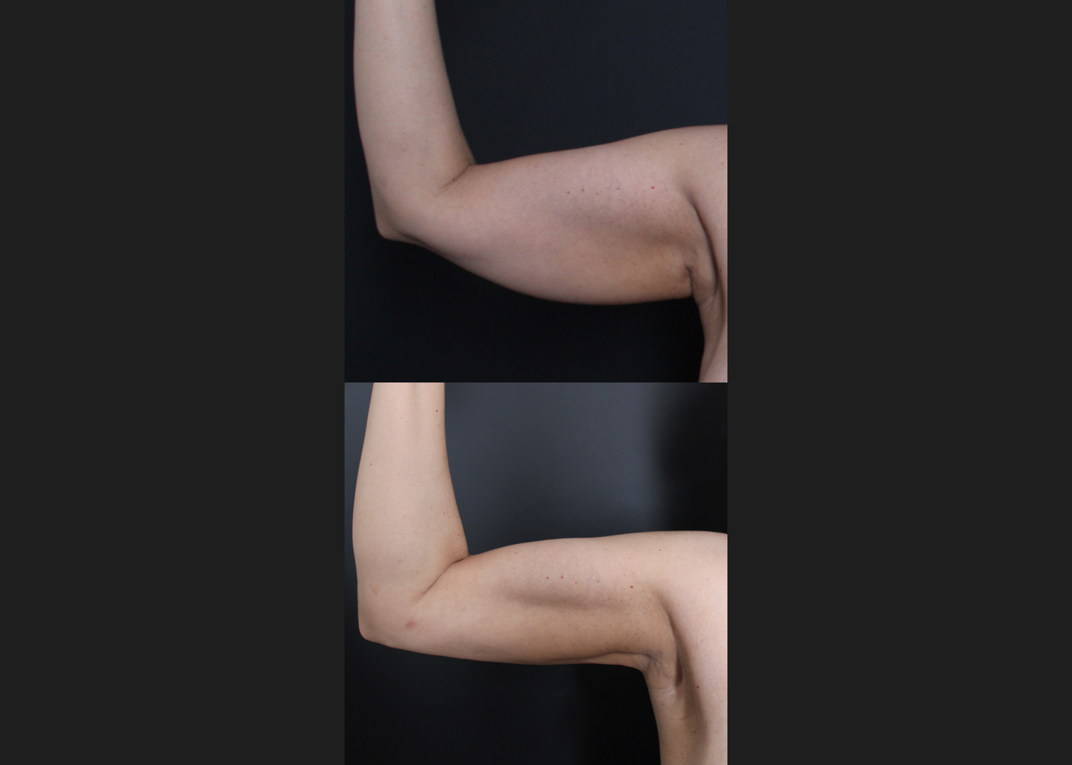 391438 Arm Vaser lipo renuvion before after- right ant