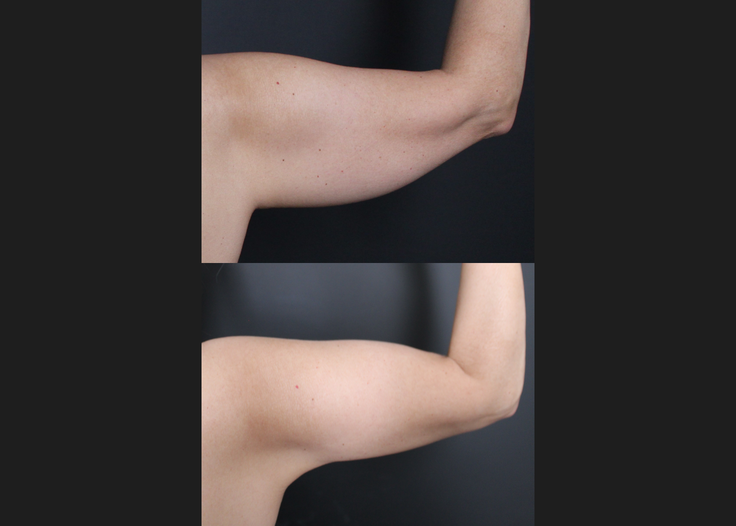 391438 Arm Vaser lipo renuvion before after- right post