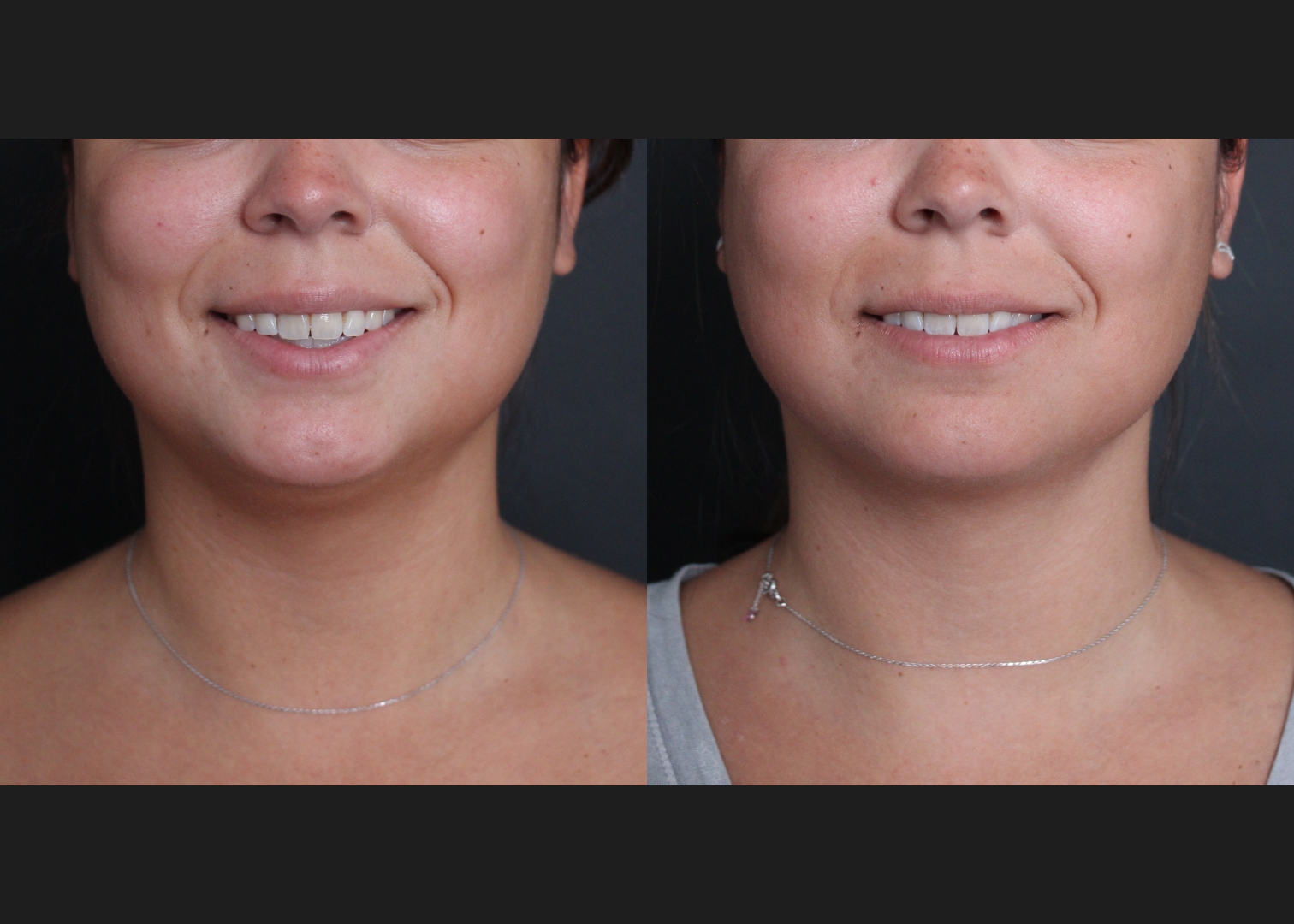 391469 submental neck vaser lipo before after- front