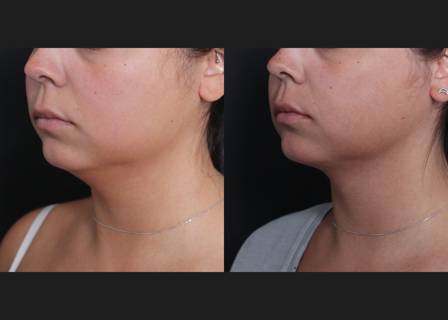 391469 submental neck vaser lipo before after- left oblique