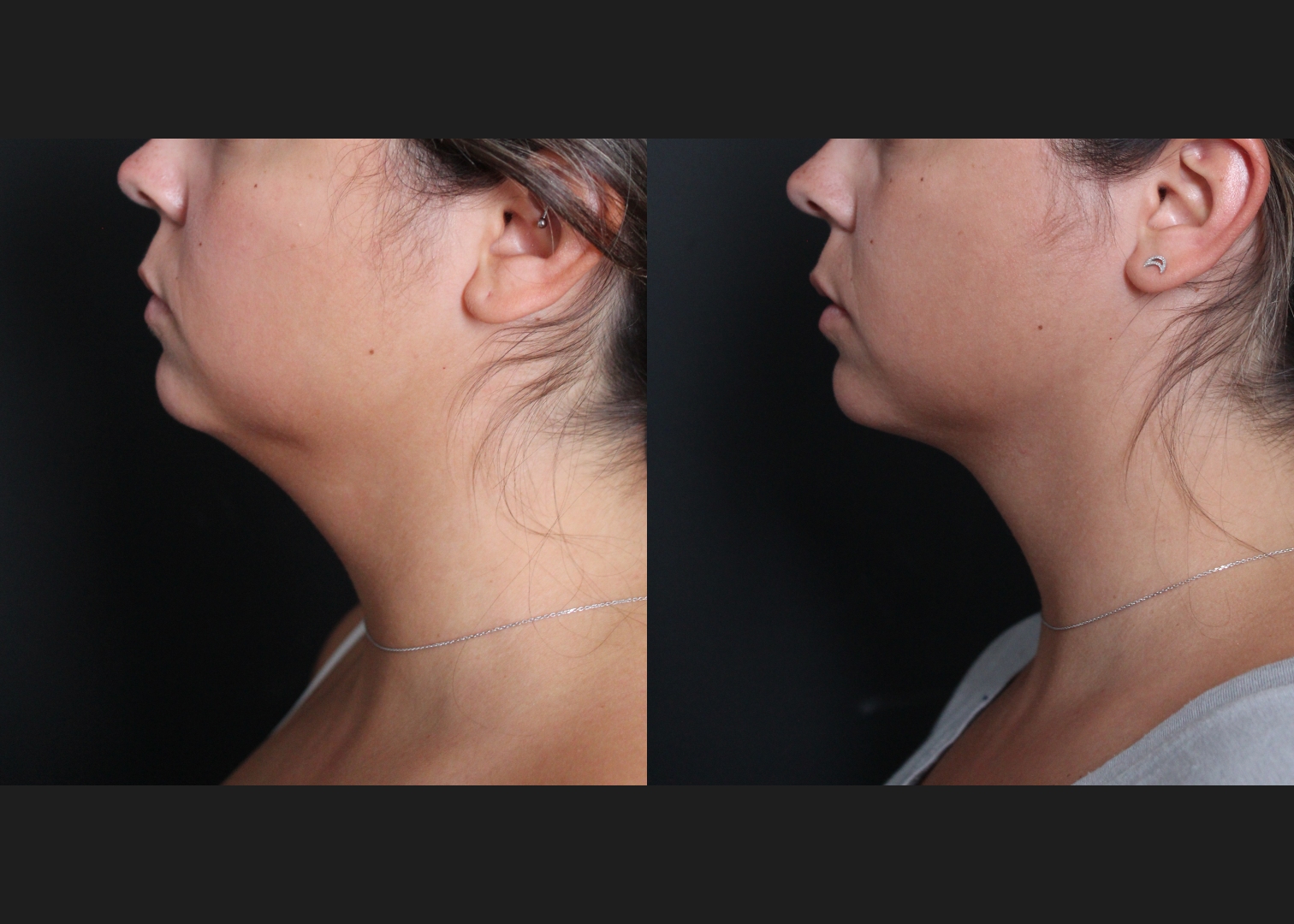 391469 submental neck vaser lipo before after- left