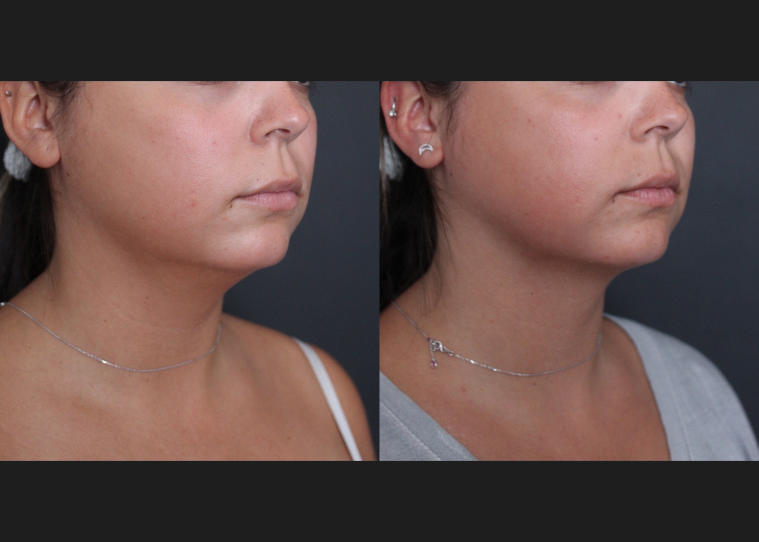 391469 submental neck vaser lipo before after- right oblique