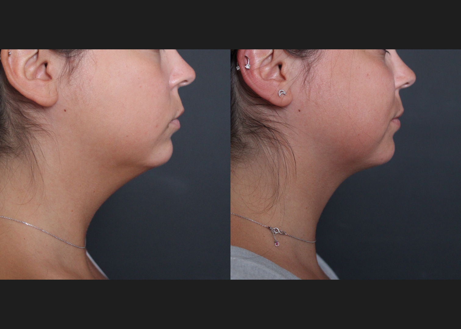 391469 submental neck vaser lipo before after- right