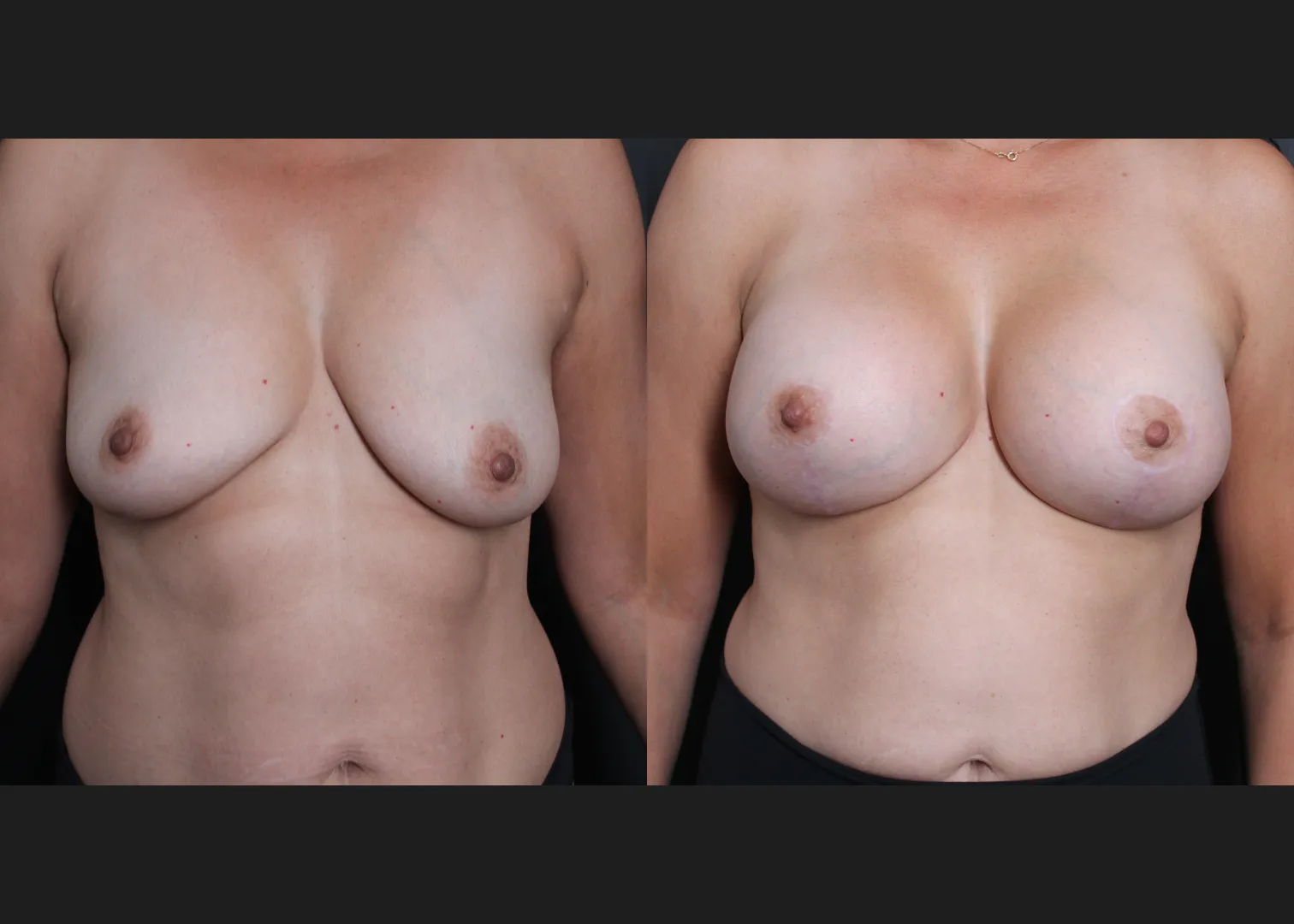 391472 Breast augmentation mastopexy lift Sientra HSC+ high profile silicone gel gummy bear implants 440 cc before after- front