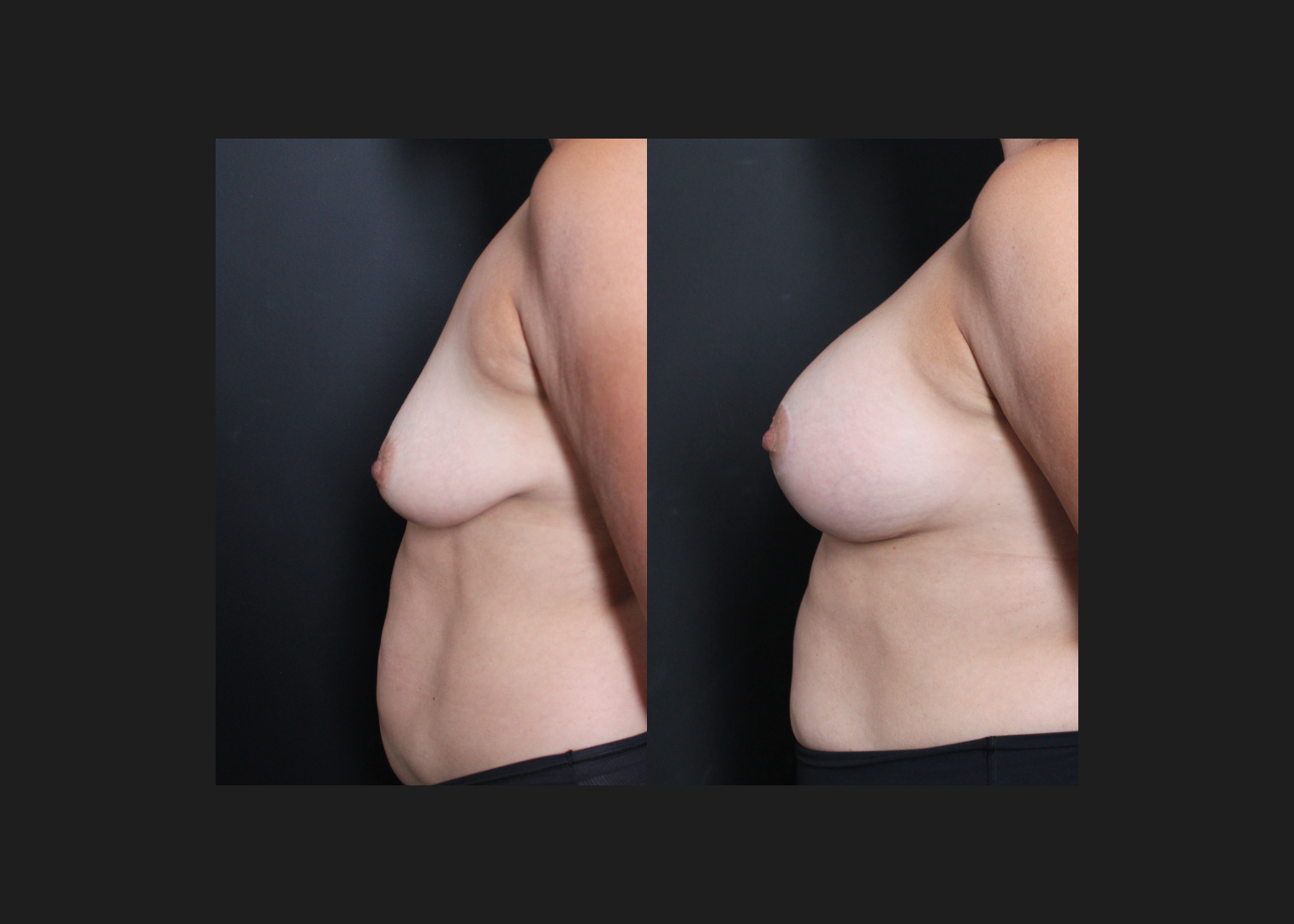 391472 Breast augmentation mastopexy lift Sientra HSC+ high profile silicone gel gummy bear implants 440 cc before after- left