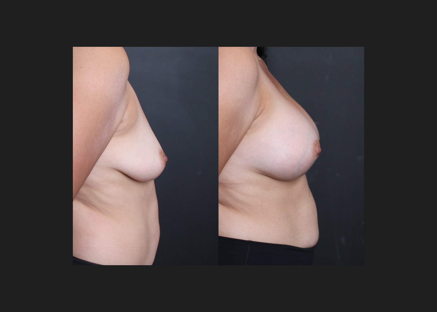 391472 Breast augmentation mastopexy lift Sientra HSC+ high profile silicone gel gummy bear implants 440 cc before after- right