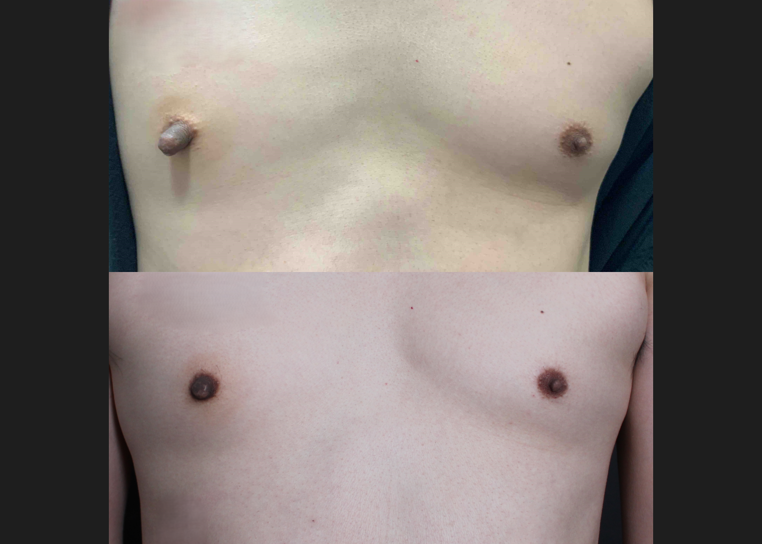 391559 Right nipple reduction tuck stretched nipple correction before after- front