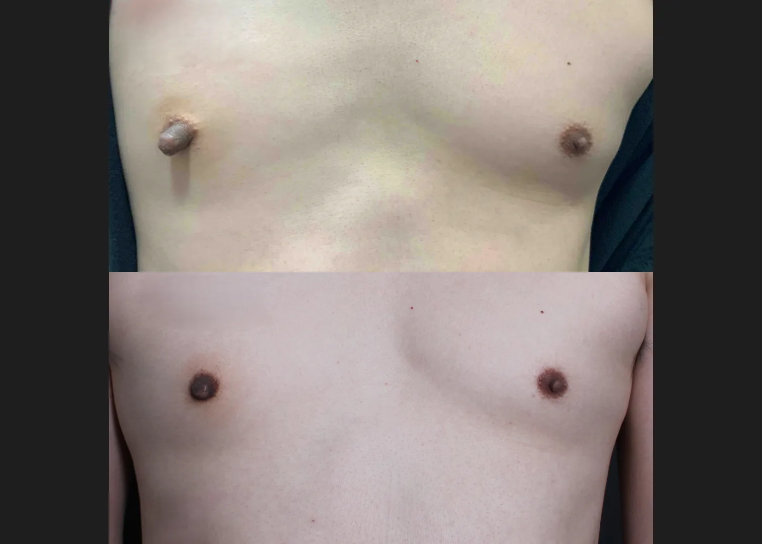 391559 Right nipple reduction tuck stretched nipple correction before after- front
