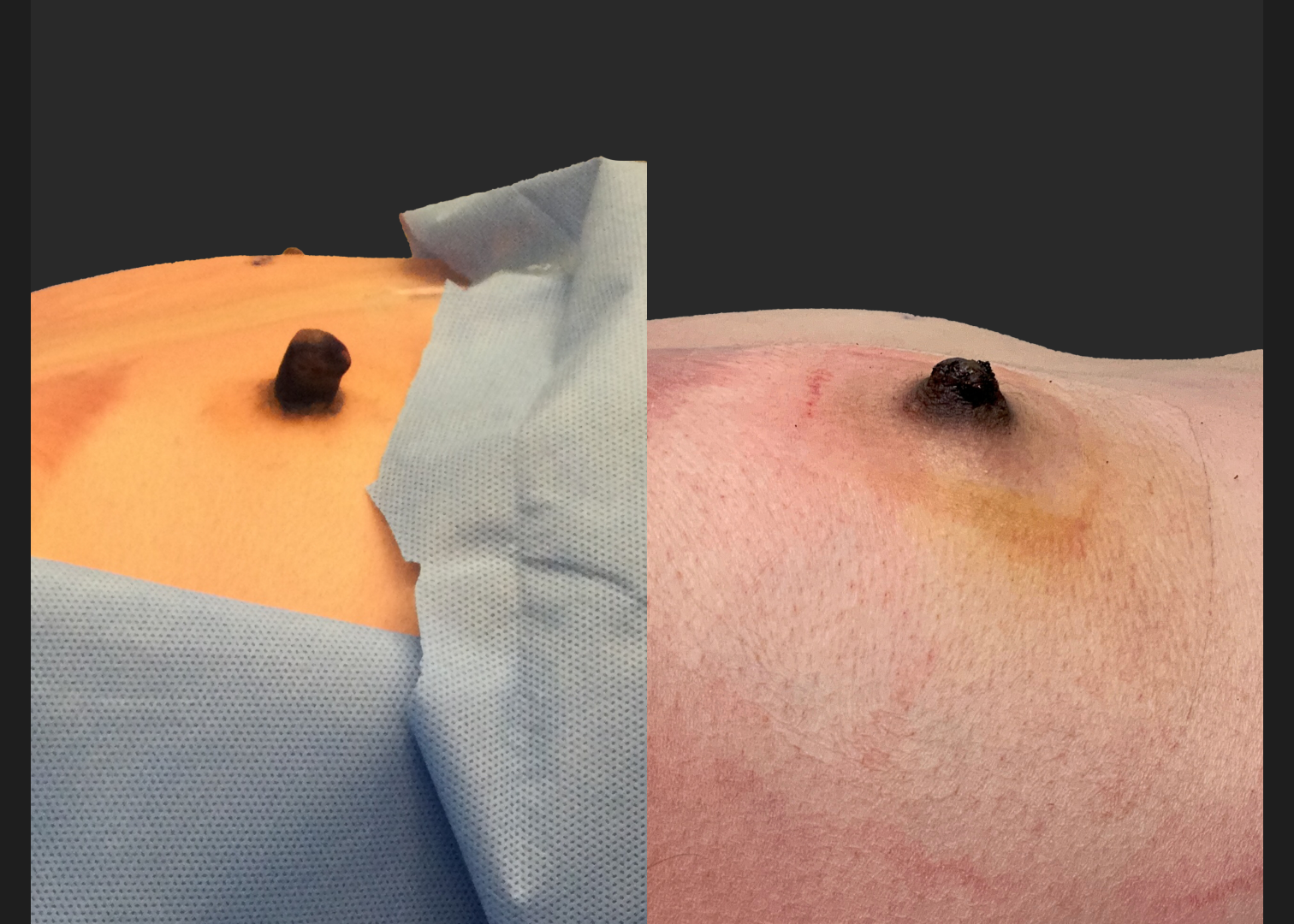 391559 Right nipple reduction tuck stretched nipple correction before after- lateral right