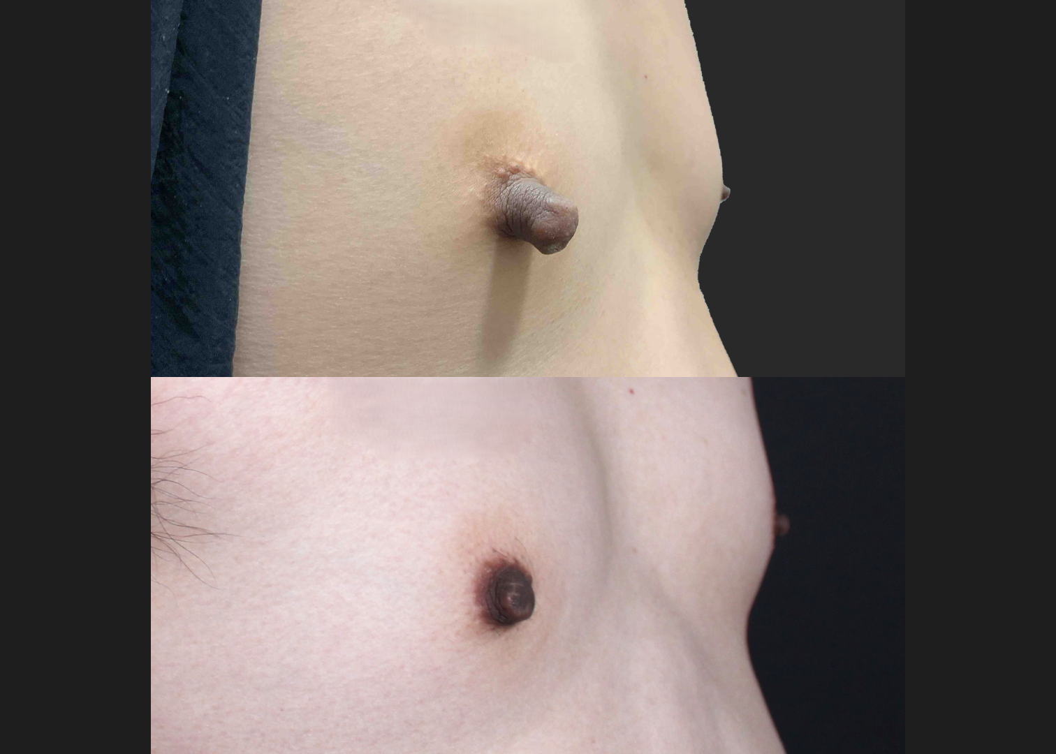 391559 Right nipple reduction tuck stretched nipple correction before after- oblique