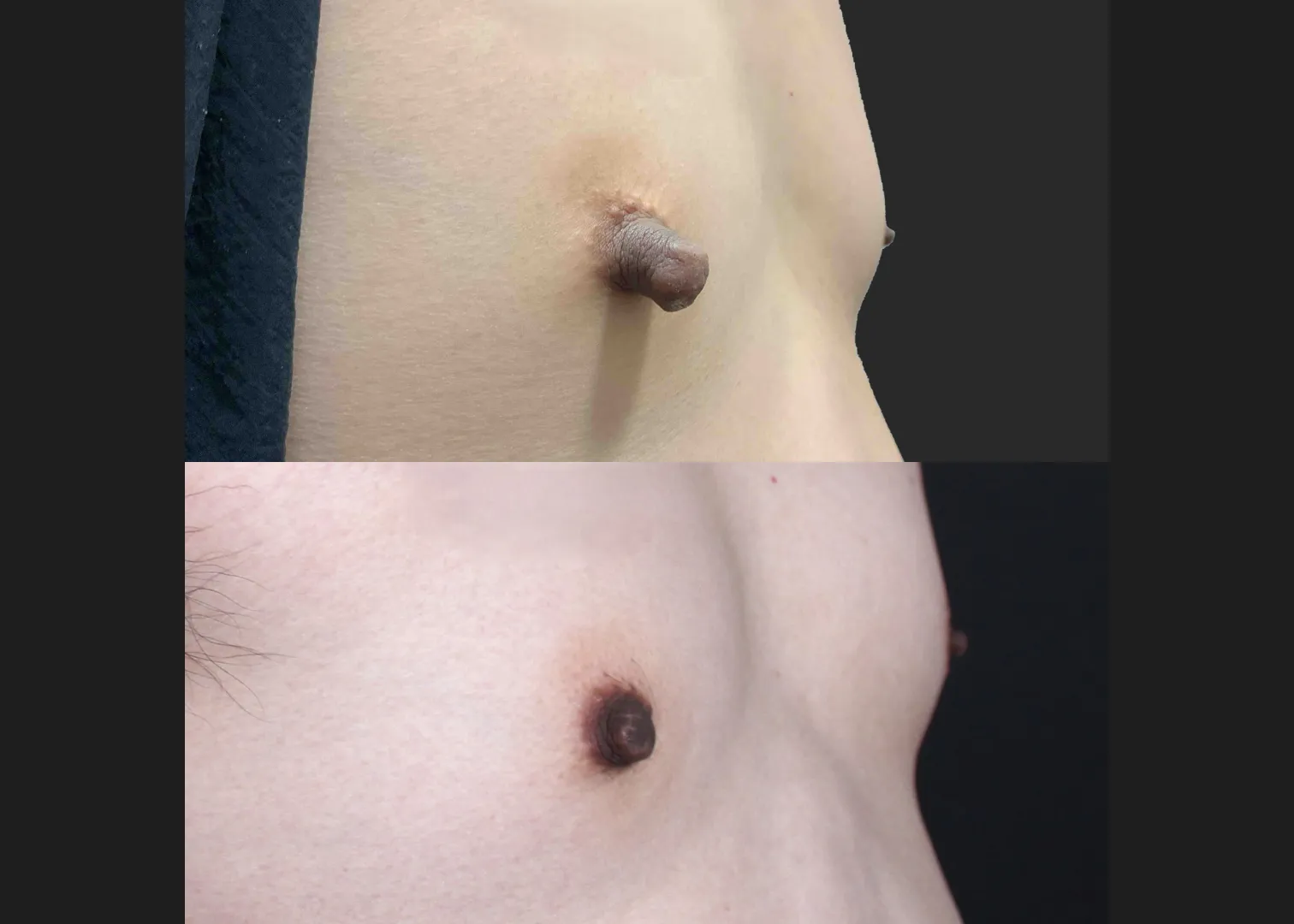 391559 Right nipple reduction tuck stretched nipple correction before after- oblique