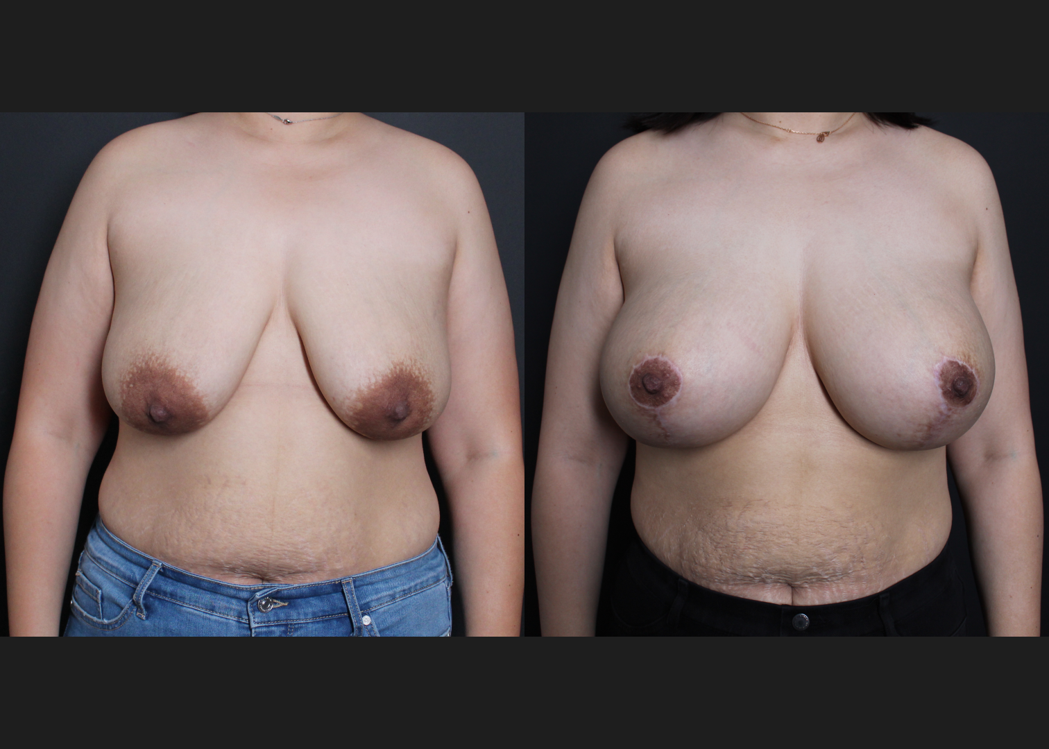 39267 Breast Augmentation mastopexy lollipop lift Sientra HSC+540 cc silicone gel gummy bear implants subfascial before after- front