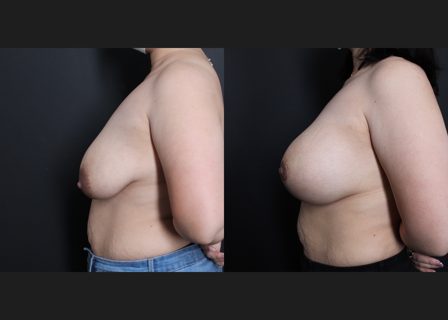 39267 Breast Augmentation mastopexy lollipop lift Sientra HSC+540 cc silicone gel gummy bear implants subfascial before after- left