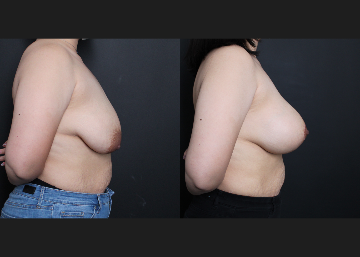 39267 Breast Augmentation mastopexy lollipop lift Sientra HSC+540 cc silicone gel gummy bear implants subfascial before after- right