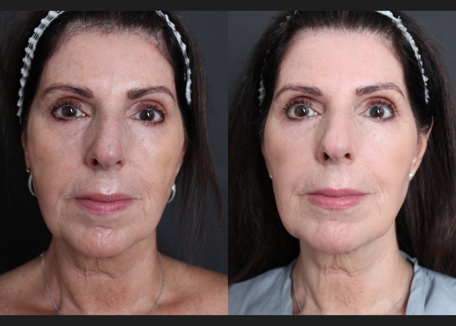 39417 facial fat transfer filler dissolving female before after- front