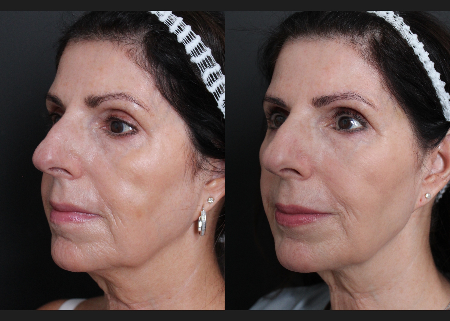 39417 facial fat transfer filler dissolving female before after- left oblique