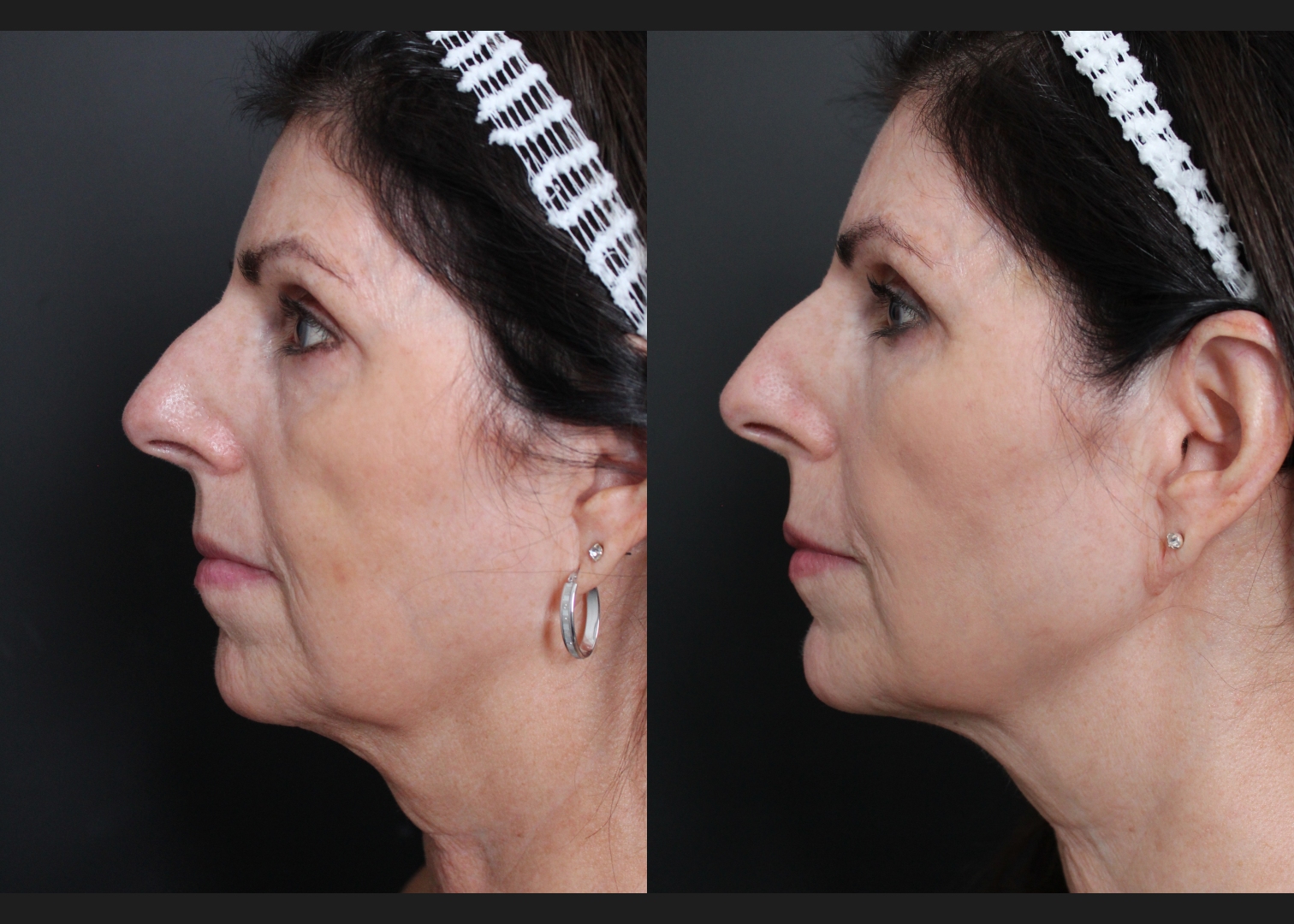 39417 facial fat transfer filler dissolving female before after- left