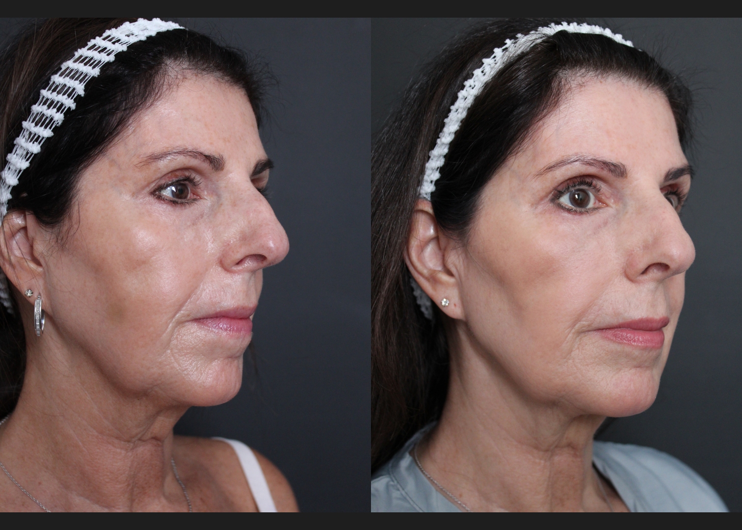 39417 facial fat transfer filler dissolving female before after- right oblique