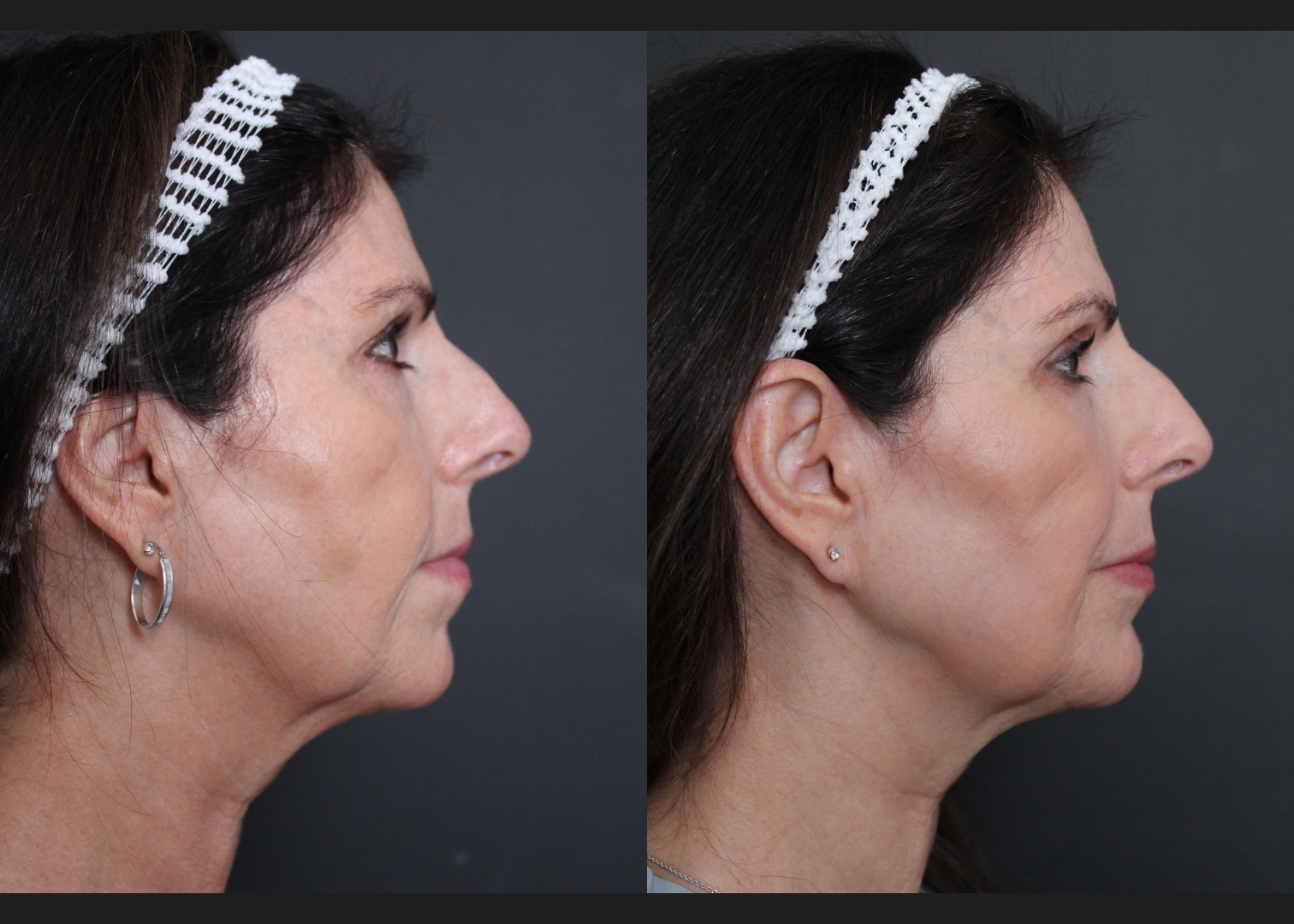 39417 facial fat transfer filler dissolving female before after- right
