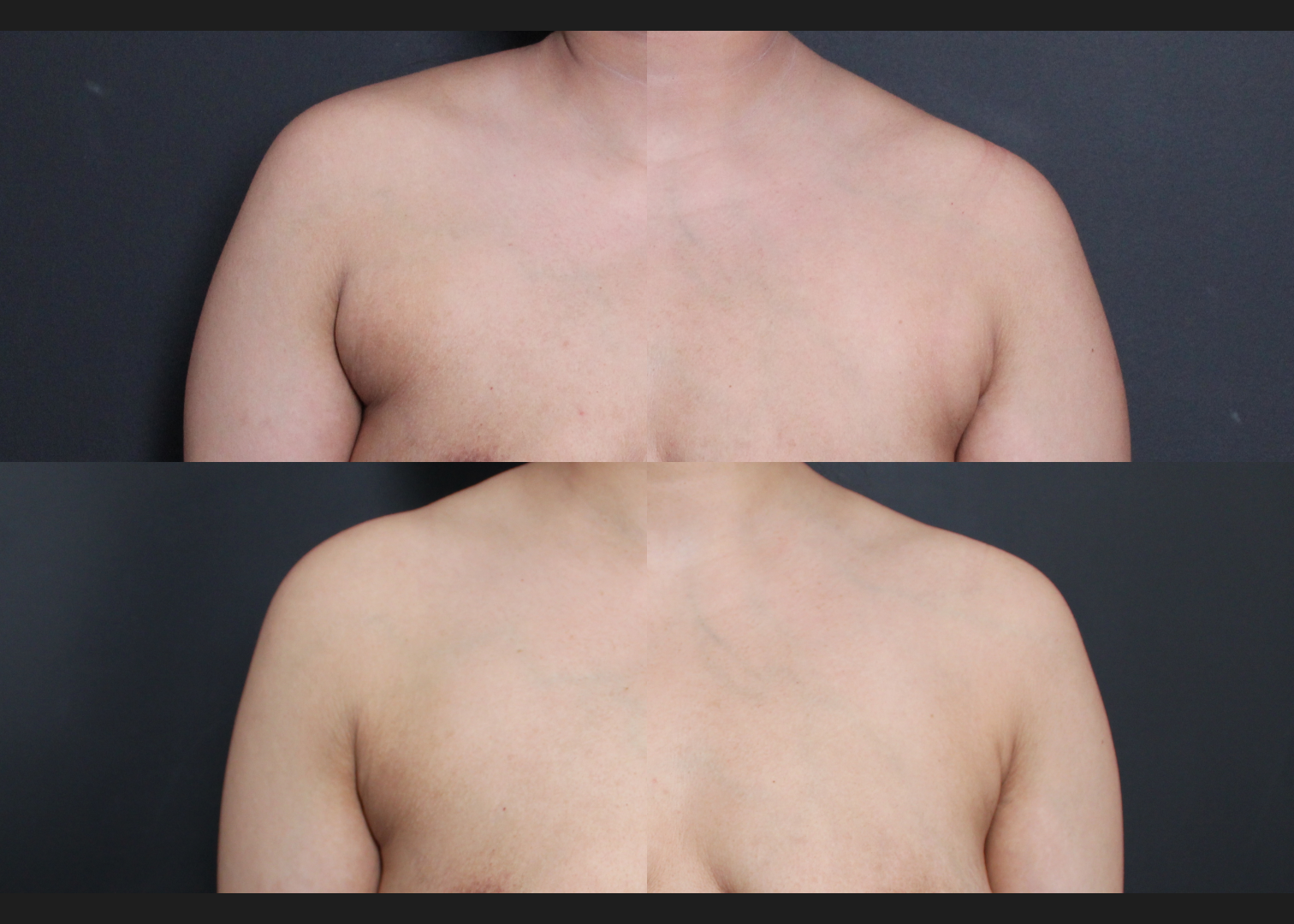 394711 Arm Axilla Lipo Renuvion anterior