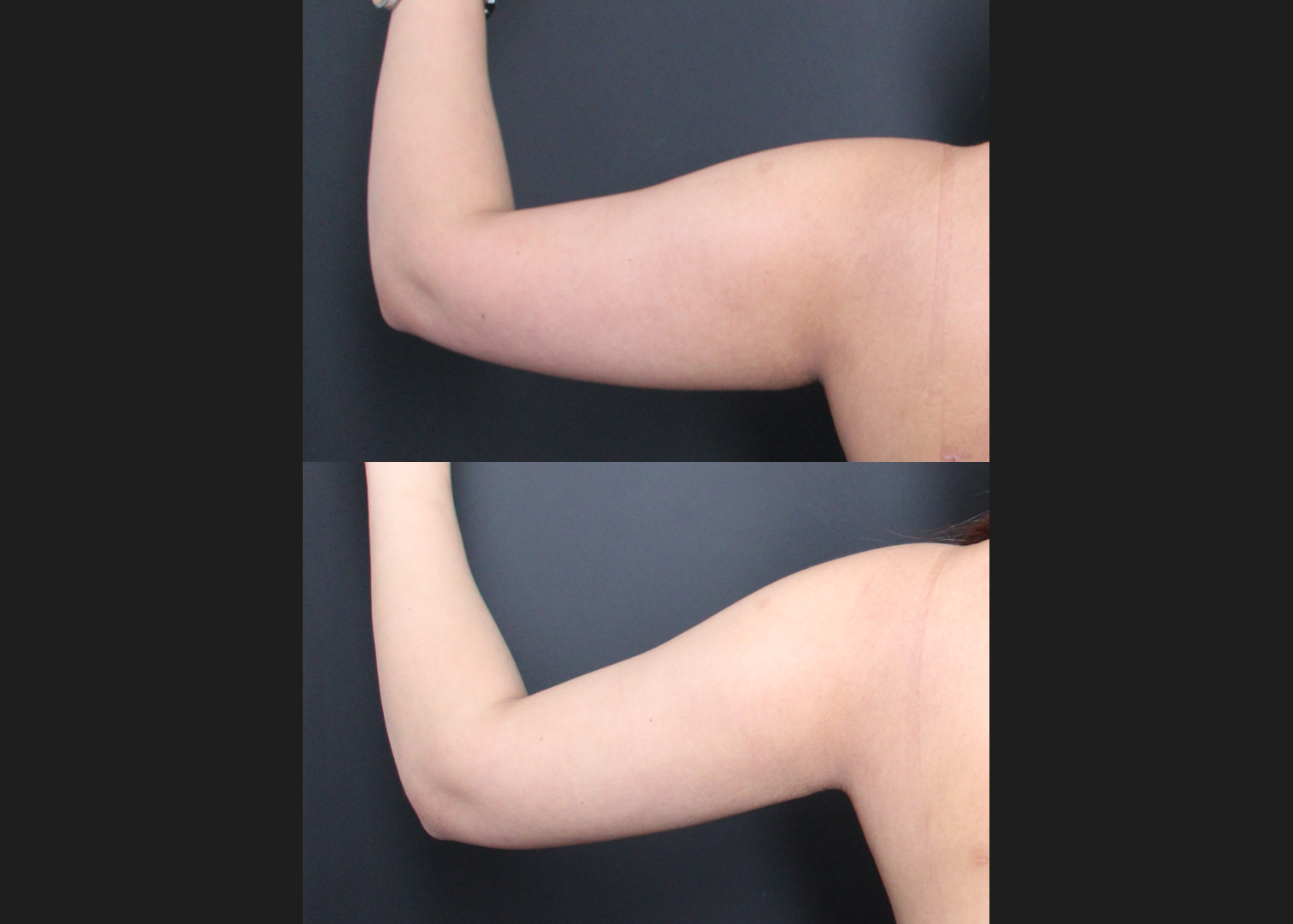 394711 Arm Axilla Lipo Renuvion left post
