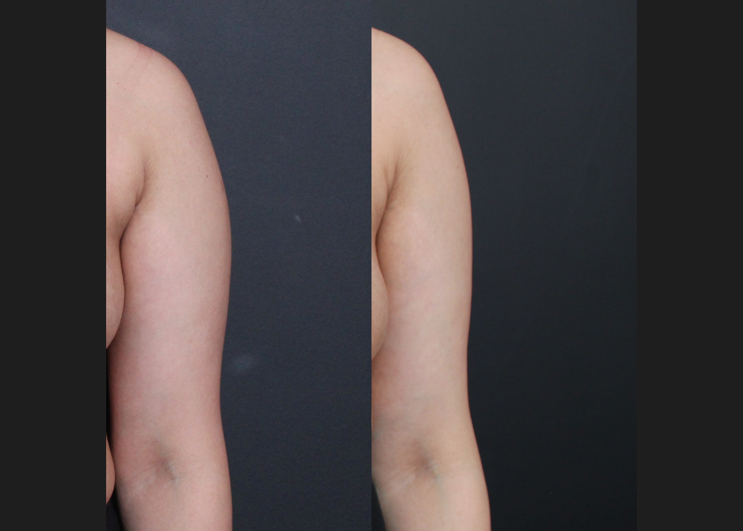 394711 Arm Axilla Lipo Renuvion left