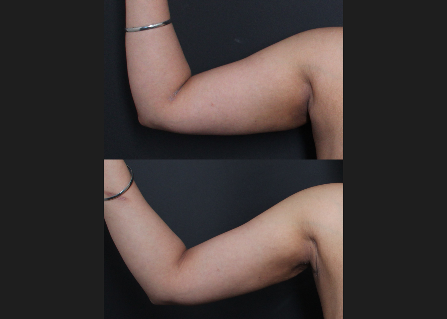 394711 Arm Axilla Lipo Renuvion right front