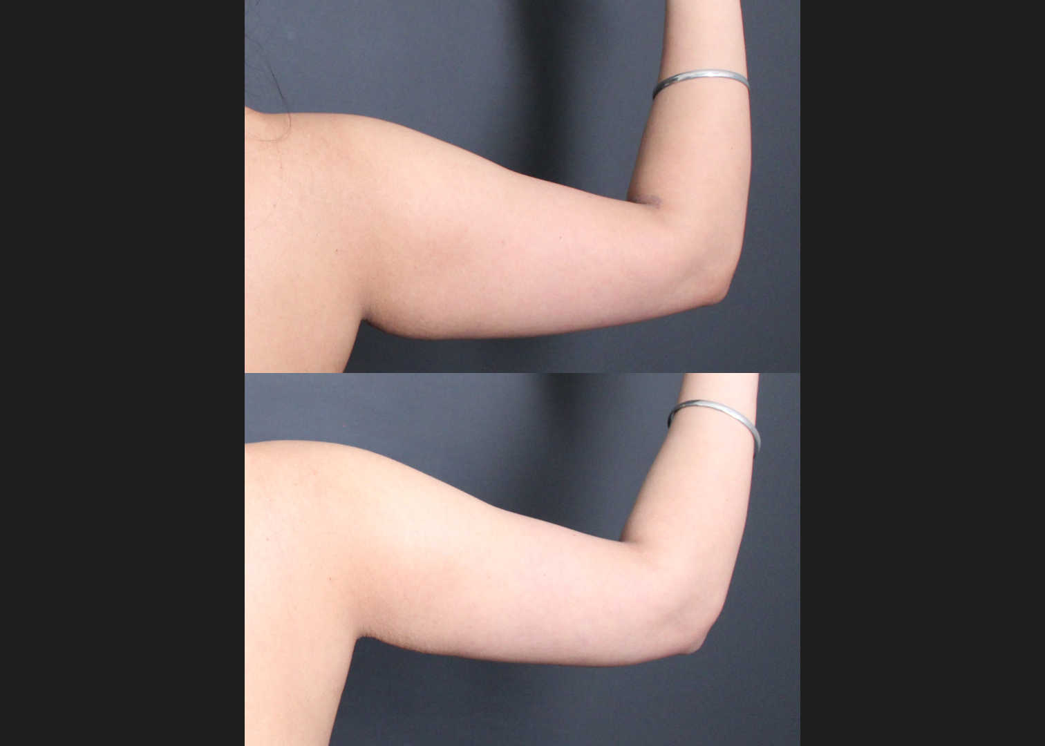 394711 Arm Axilla Lipo Renuvion right post